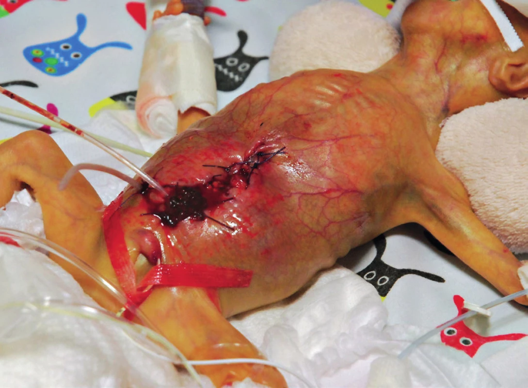Extrémně nedonošený pacient (t. hm. 550 g), stav po druhé operační revizi
Patrné jsou střevní stomie, napjatá břišní stěna a krvácející dehiscence operační rány.