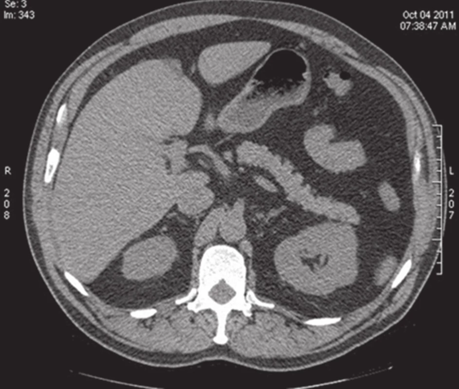 CT jater nativní − stejný pacient hypodensní okrsek v S4 patřící pseudolézi.
Fig. 2: Non-contrast CT scan of the liver – the same patient, hypo-dense area in segment S4 representing the pseudolesion.