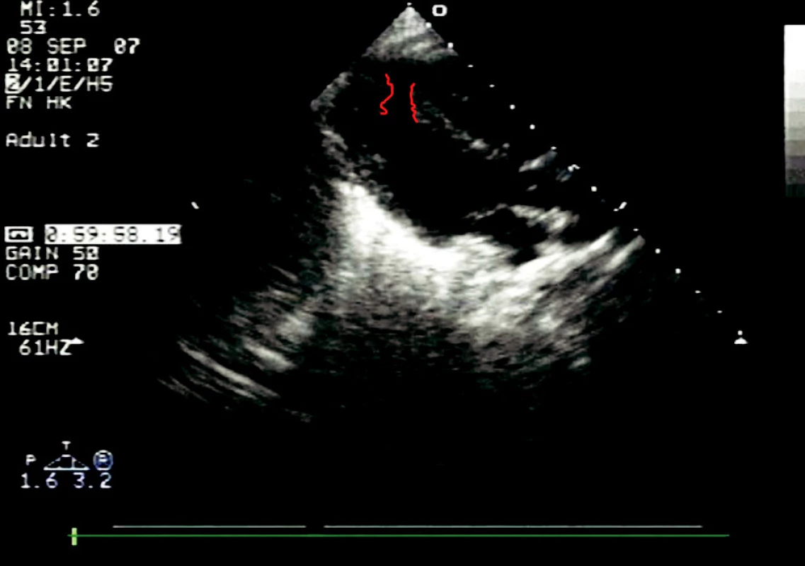 Parasternální projekce v dlouhé ose se zobrazením levé komory. Červeně je zvýrazněn defekt septa komor
Fig. 3. Parasternal projection along the longitudinal axis, depicting the left ventricle. The ventricular septal defect is highlighted in red