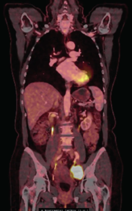 PET-CT zobrazující lymfatickou metastázu v malé pánvi
Fig. 5: PET-CT showing a lymphatic metastasis in the pelvis