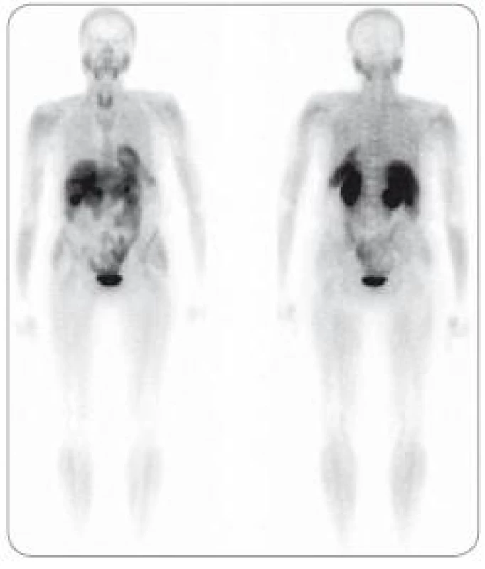 Mnohočetný myelom ve stadiu III, suspektní relaps. Na celotělových &lt;sup&gt;99m&lt;/sup&gt;Tc-MIBI scintigramech neprokazána patologická akumulace radiofarmaka v kostní dřeni ani extramedulárně. Relaps neprokázán.