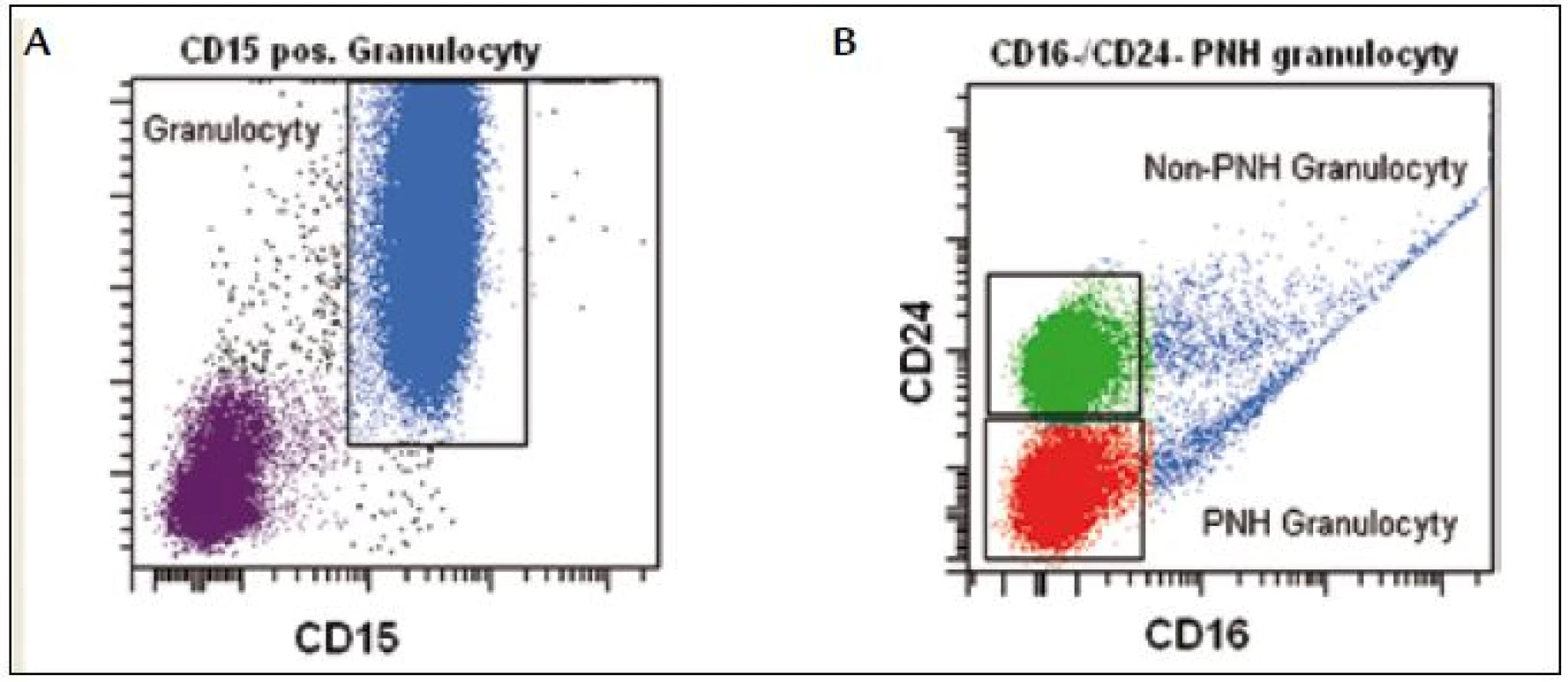 Granulocyty definujeme na základě vysokého SSC a silné exprese znaku CD15 (A). PNH granulocyty jsou CD16&lt;sup&gt;neg&lt;/sup&gt;/CD24&lt;sup&gt;neg&lt;/sup&gt;. Non-PNH granulocyty (CD24&lt;sup&gt;pos&lt;/sup&gt;) u pacienta s MDS vykazují patologickou nepřítomnost znaku CD16 (B).