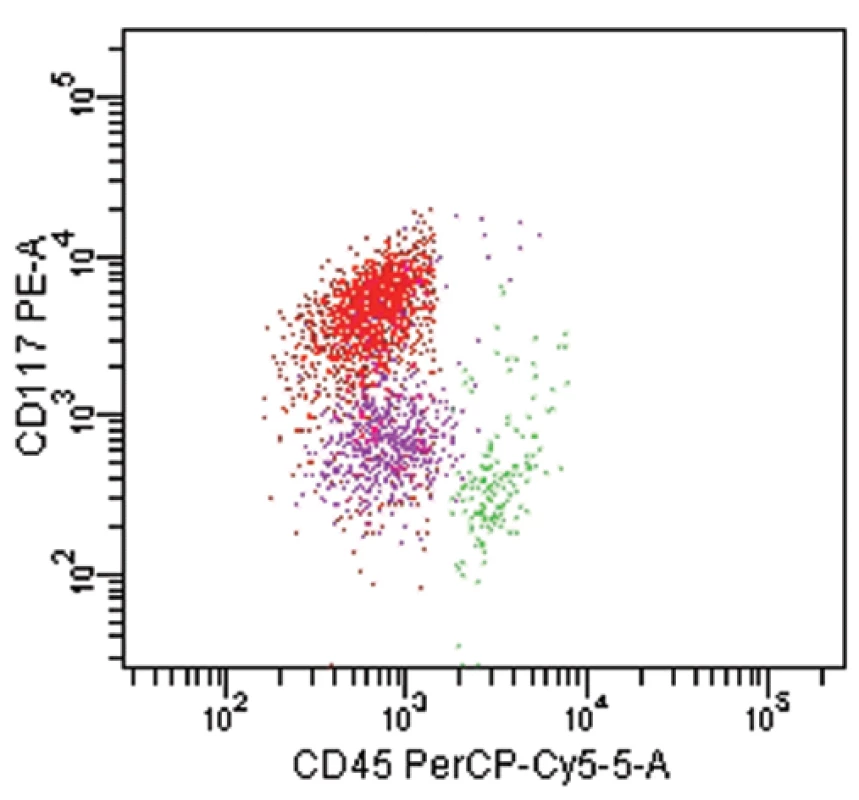 Akutní bifenotypová leukemie dle EGIL (WHO 2001). Fenotyp leukemické populace (červeně): CD45 slabě, CD19+, cCD22+, cCD79a+, CD33+, CD13slabě, CD117+. Skóre pro B-lymfoidní řadu- 3, skóre pro myeloidní řadu-3.