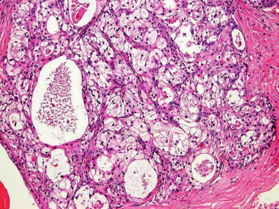 Světlobuněčná varianta mukoepidermoidního karcinomu: nádorové buňky s vodojasnou cytoplasmou tvoří většinu nádoru (Hematoxylin-eosin).