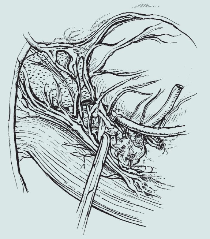 Anatomie pánve – linie disekce v případě šetření nervově-cévního svazku [3].