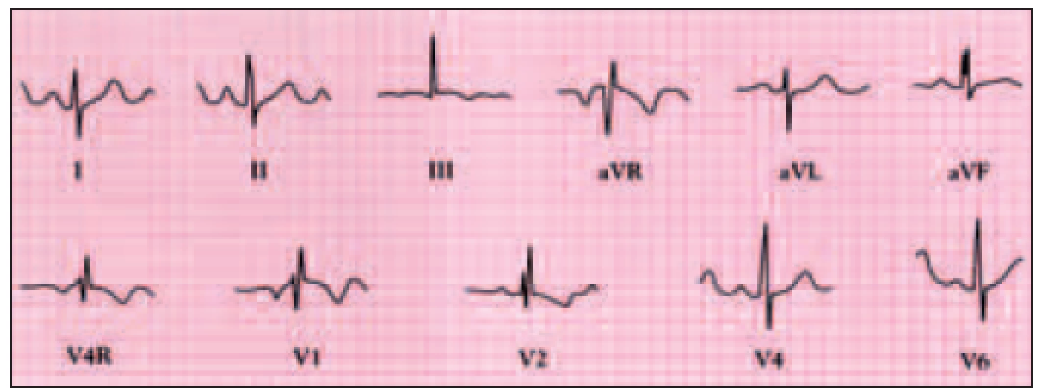 Elektrokardiogram pacienta s defektem septa síní typu ostium secundum ukazuje sinusový rytmus, deviaci osy doprava, komplexy rsR’ od V4R do V4 vlivem nekompletní blokády pravého raménka.
