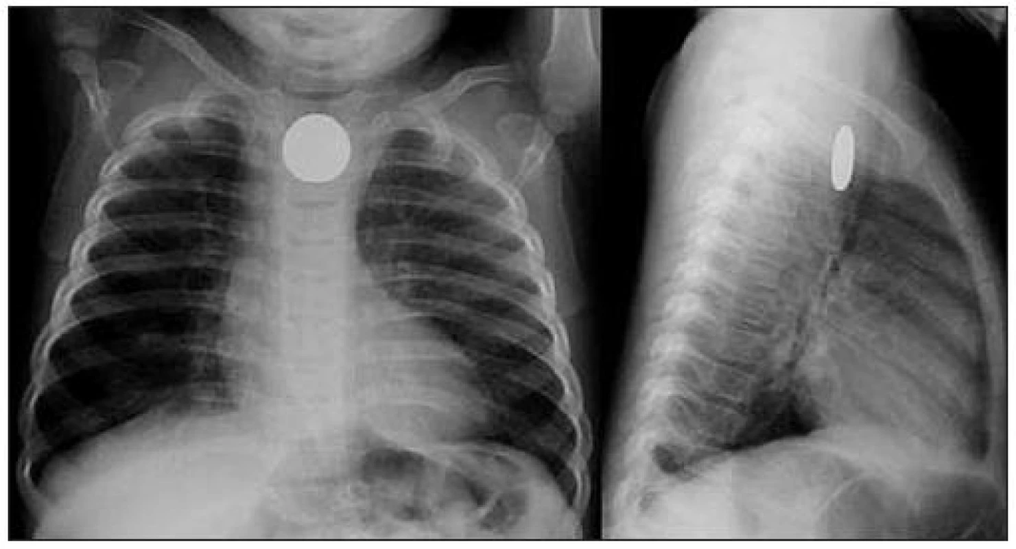 Předozadní a boční rtg snímek hrudníku – mince je uložena v jícnu.
Fig. 2. Anteroposterior and lateral chest X-ray where is the coin in esophagus.