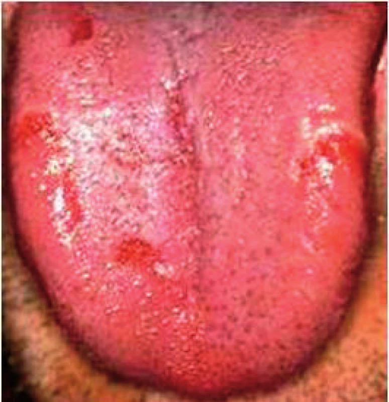 Povlak je normálný, na povrchu jazyka sú čerstvé erozie. Stav je u recidívnej infekcii &lt;i&gt;Helikobakter pylori&lt;/i&gt; (Ďurovič)