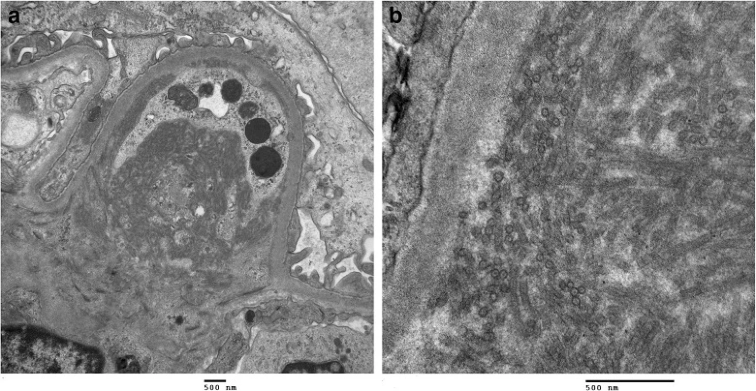 Kidney biopsy. a Kidney biopsy histology with H&amp;E staining shows an increased lobular pattern with mesangial expansion in the glomeruli. b Electron microscopy images at 15000x and 60000x magnification reveals broad tubular structures located in subendothelial and mesangial areas of the glomeruli, measuring 30 nm in diameter. The kidney biopsy was consistent with ITG