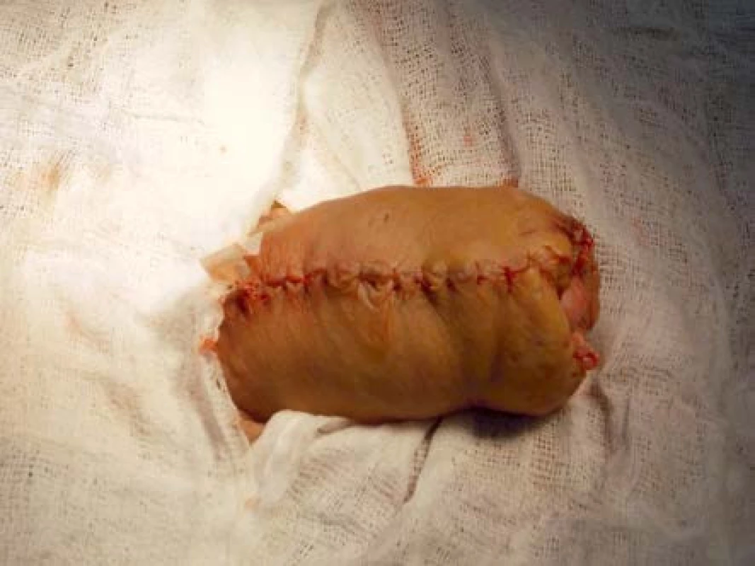 Výsledná sutura po první operaci
Fig. 5. Resulting suture after the first operation