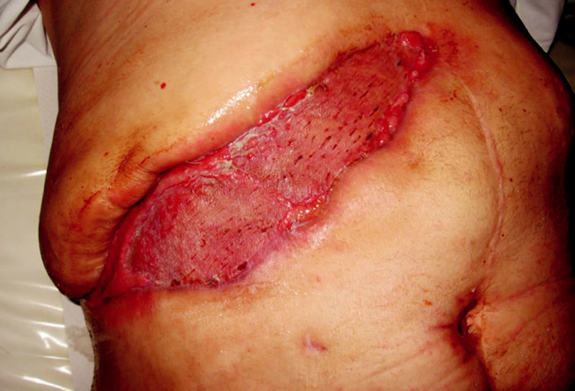 Po krytí dermoepidermálním štěpem
Obr. 4. After dermoepidermal skin graft
