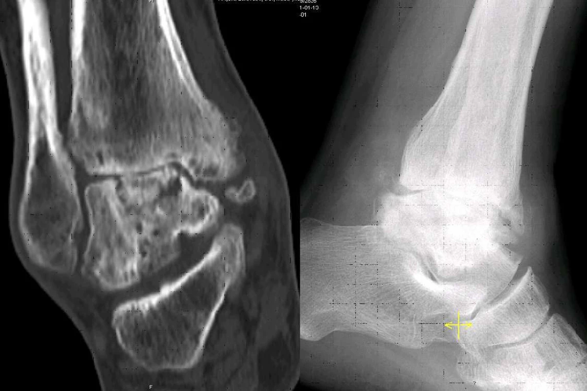 Avaskulární nekróza těla talu s rozvojem artrózy (CT koronální rovina a rtg bočný snímek)