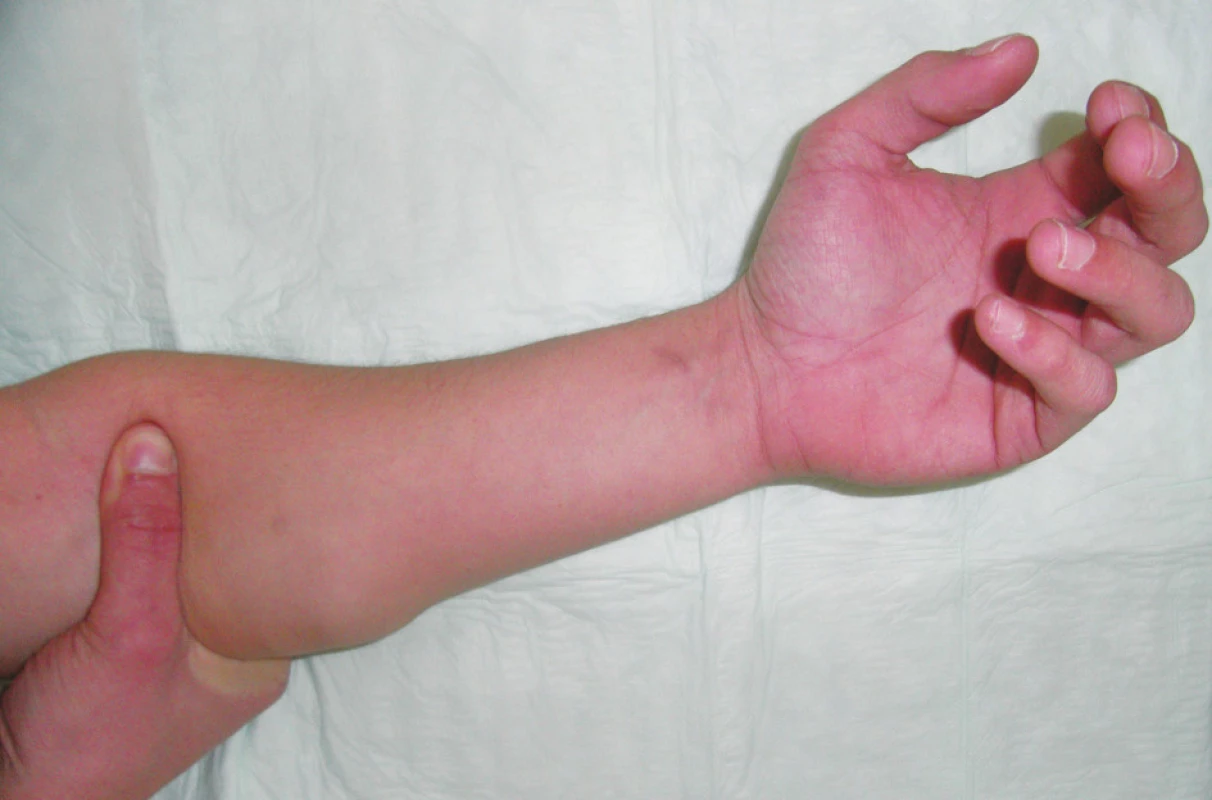 Natívny pohľad na herniu predlaktia
Fig. 1. Native view of the forearm hernia