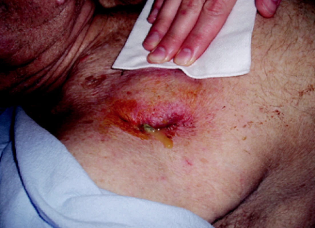 Infekce v kapse kardiostimulátoru