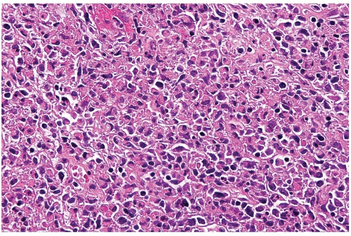 Detail hranice nekrotického úseku s akumulací makrofágů, často s lateralizovanými prohnutými jádry – tzv. srpkovité makrofágy. Barveno hematoxylinem a eozinem (zvetšení 200x).