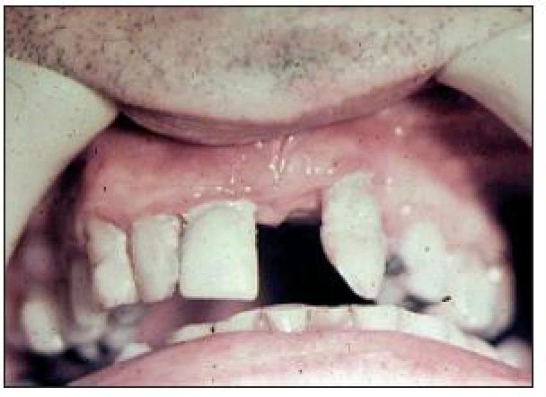 Pokročilá parodontitida u diabetiků (DM2T).