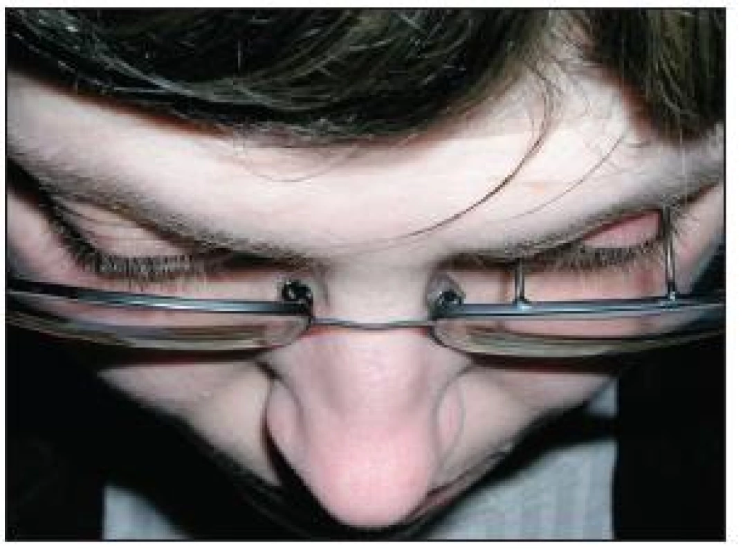 Foto ptózové podpěry upevněné na levou brýlovou obrubu – pohled shora