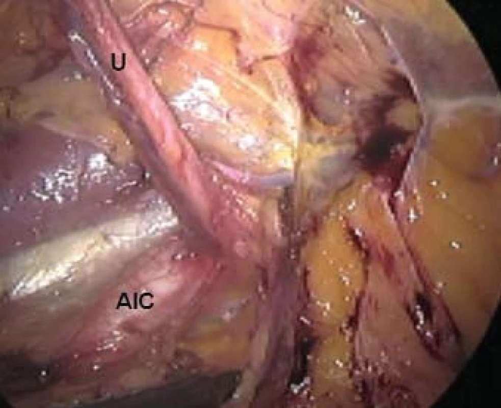 Snímek pořízený z videozáznamu z laparoskopie. Ureter vlevo je vypreparovaný až k ilickým cévám. U - ureter, AIC - arteria iliaca communi.