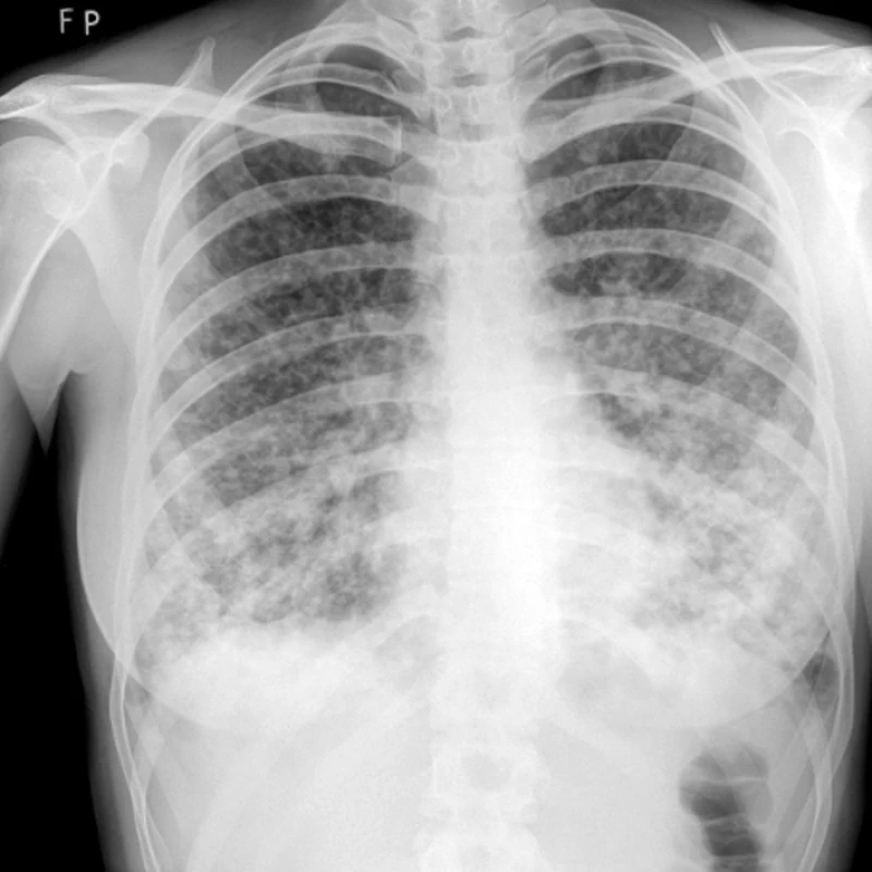 RTG – mnohočetné plicní postižení u plicního epitelioidního hemangioendoteliomu.