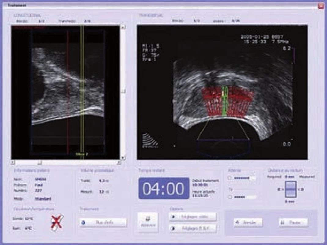 Peroperačně: trojrozměrný, transrektální ultrazvuk v reálném čase pro vizuální plánování léčby a kontrolu na kontrolním monitoru.