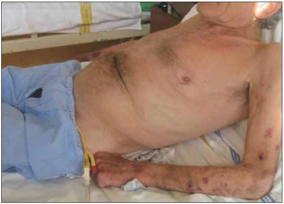 Kachexie provází zejména pokročilá stadia CHOPN, je spojena s vyšším rizikem úmrtí (na obrázku 65letý muž se soudkovitým hrudníkem při výrazné hyperinflaci plic, na horních končetinách je patrná atrofie svalů a na pokožce krvácení při dlouhodobé léčbě systémovými glukokortisteroidy) (foto autor).