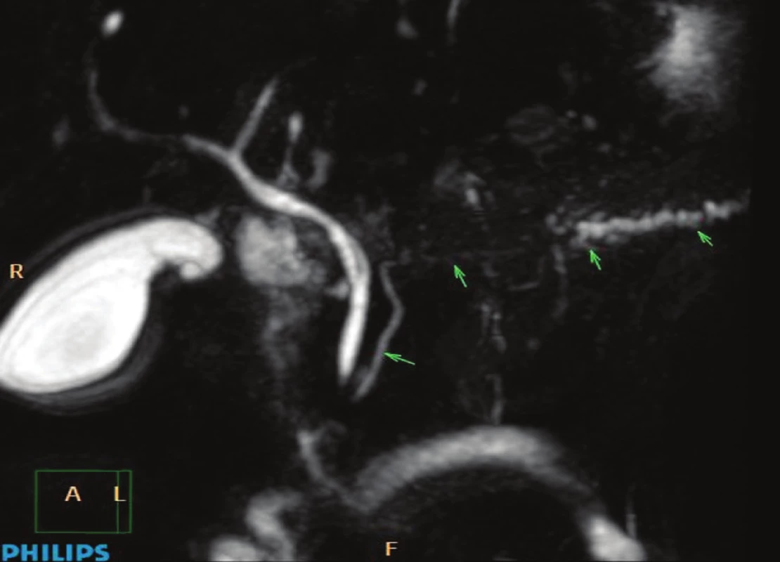 Magnetická rezonanční pankreatografie se zobrazením normální morfologie pankreatického vývodu v oblasti hlavy pankreatu, chybějící náplň v oblasti těla žlázy a dilatace v oblasti kaudy pankreatu za vývod stenozující maligní lézí slinivky břišní