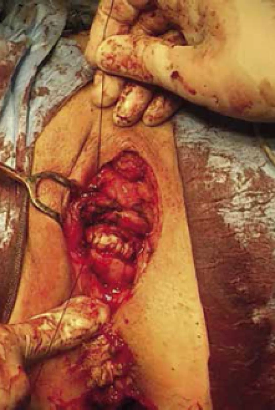 Radikální excize tumoru – sutura močového měchýře
