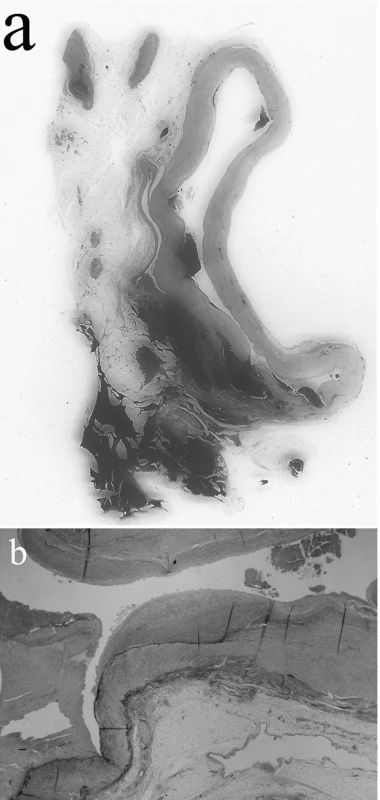 Cross section of the splenic artery aneurysm (a; H&amp;E staining) and destruction of the internal elastic lamina (b; EVG staining, objective x2)