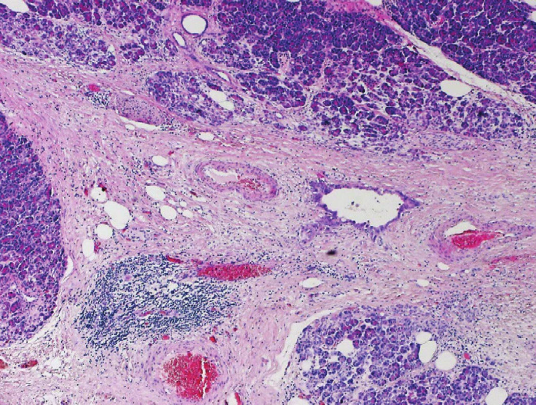 Pankreatický duktální adenokarcinom (PDA). Interlobulární fibrotizované septum s přítomností nepravidelné duktální formace PDA bez zjevné destrukce přiléhajících lobulárnû formovaných struktur pankreatu. Barveno hematoxylinem  eozinem (zvětšení 40x).