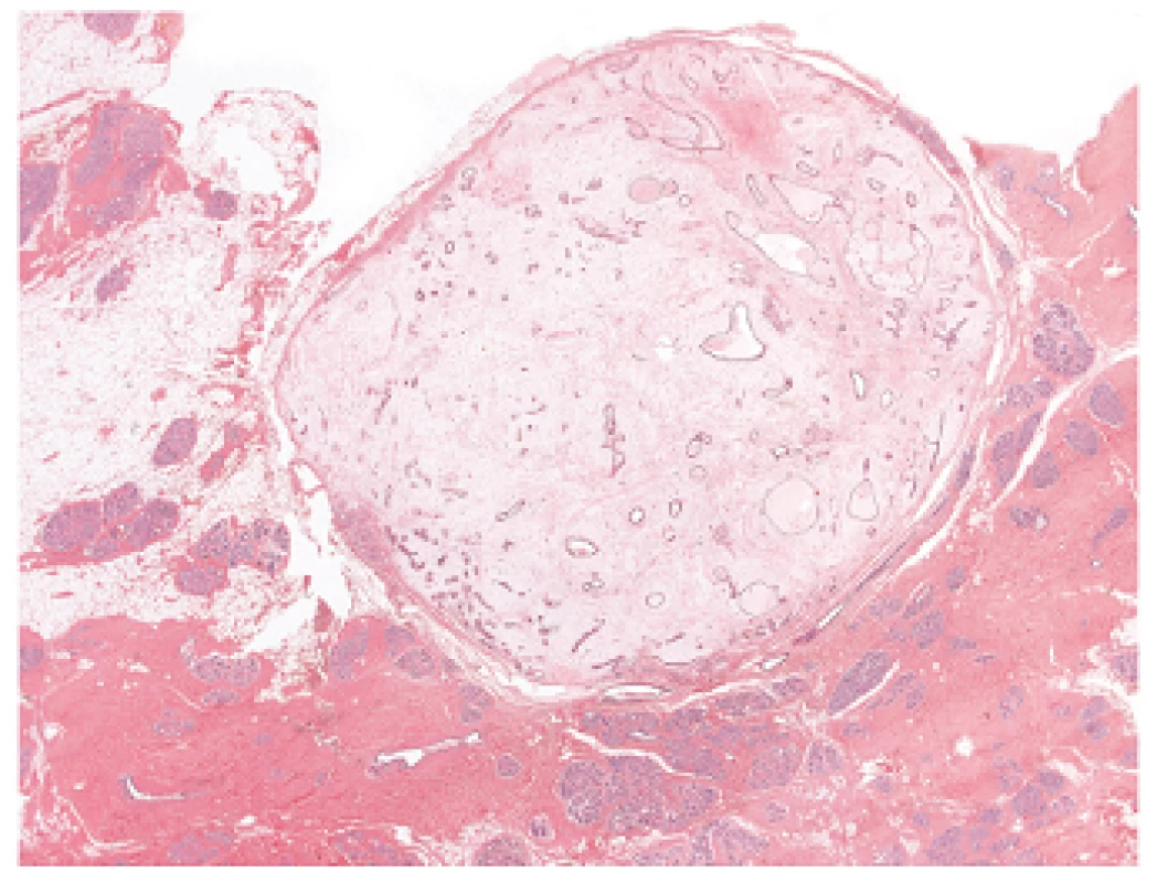 Myxoidní fibroadenom prsu vykazující typický obraz fibroadenomu v kombinaci s ložisky myxoidního stromatu chudého na buňky. Barveno hematoxylinem eozinem (zvětšení 12,5x).
