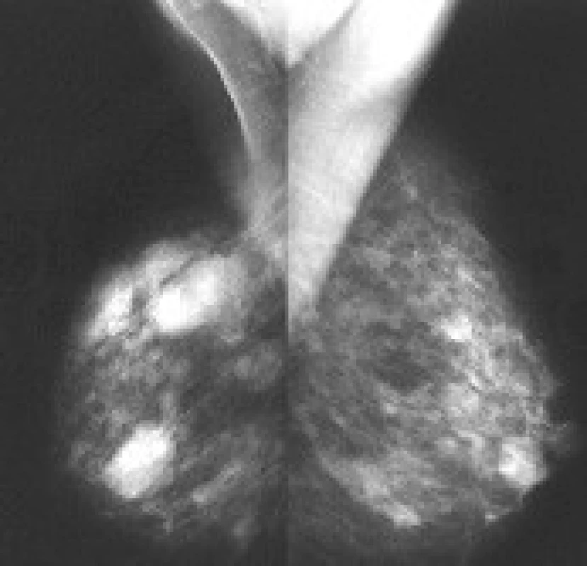 Nefrocystický snímek prsů: 55letá pacientka před léčbou tibolonem (1/2005).