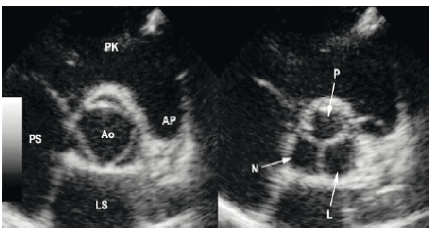 Aortální chlopeň v transverzálním řezu, AV PSAX
