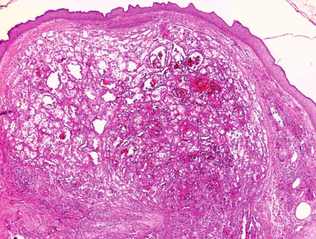Histologický obraz metastázy karcinomu ledviny (HE, 40x).