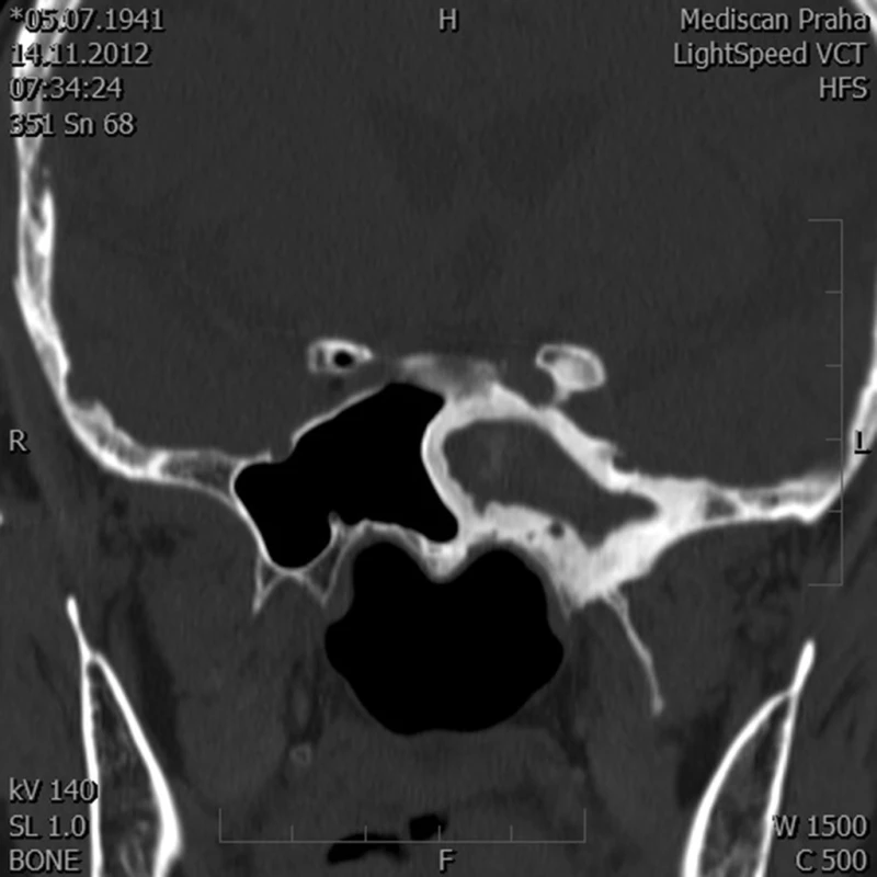 CT pacienta se sfenoidální sinusitidou vlevo, která se projevovala několikaměsíčními retrobulbárními bolestmi