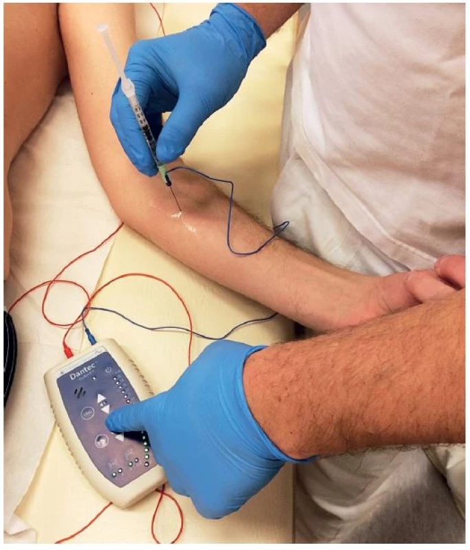 Aplikace botuloxinu do svalu za použití EMG stimulace.