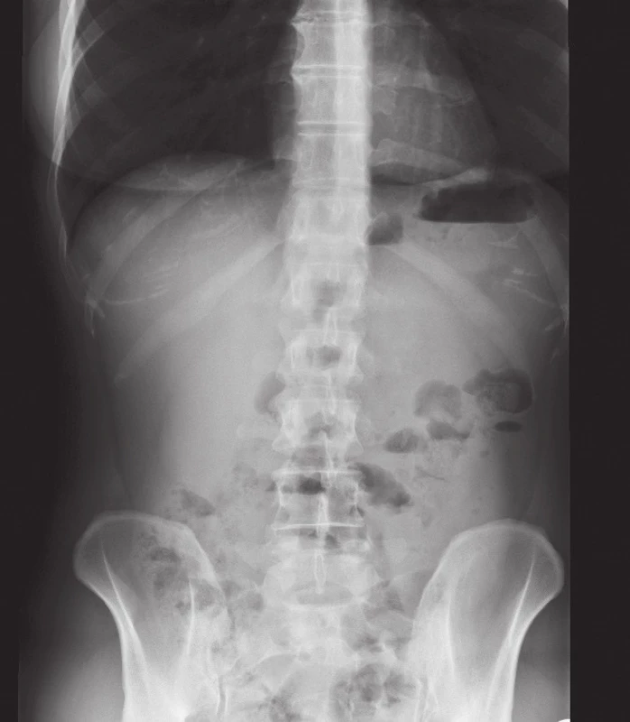 RTG obraz vnitřní kýly
Fig. 2: X-ray scan of internal hernia