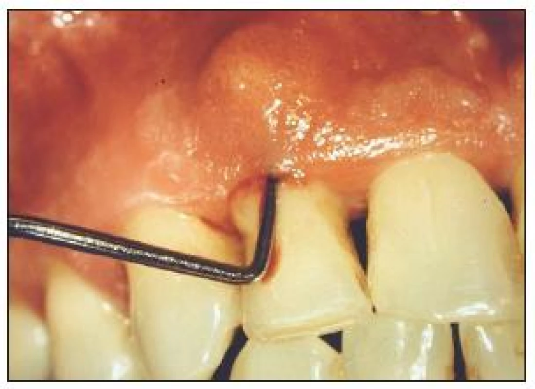 Parodontální absces vyskytující se u diabetiků.