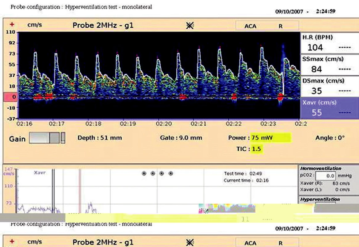 Hyperventilační test
V dolním okně záznam maximální průměrné rychlosti (Xavr) na a. cerebri media l.dx. při normoventilaci, následuje záznam maximální průměrné rychlosti (Xavr) při hyperventilaci 25 dechů/min s charakteristickým poklesem této rychlosti navozenou hypokapnií.