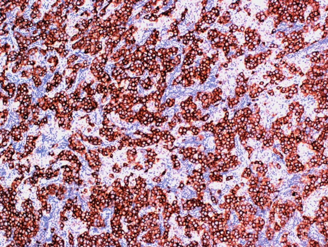 Imunohistochemický dôkaz placentálnej alkalickej fosfatázy v nádorových bunkách seminómu v metastatickom ložisku v retroperitoneu (zväčšenie 100×; PLAP)
Fig. 5. Immunohistochemical staining of placental alkaline phosphatase in neoplastic cells of seminoma in the retroperitoneal lymph node metastasis (magnification 100×; PLAP)