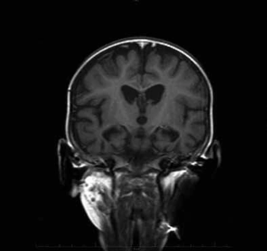 MR mozku dítěte s mitochondriální encefalopatií a neurogenní svalovou atrofií ve věku 13 měsíců (pacient 1).
