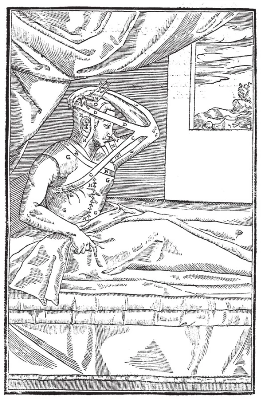 Originální ilustrace pacienta s plastikou nosu, dnes zvanou italská metoda
