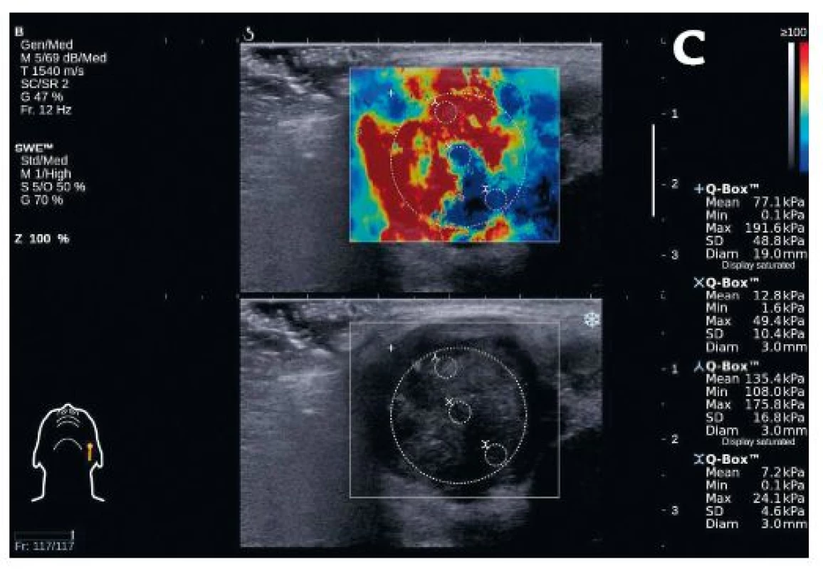 Obraz maligního tumoru příušní žlázy u 75leté pacientky – ve standardním ultrazvukovém zobrazení (A) je patrná převážně hypoechogenní, neostře ohraničená formace s nepravidelnými okraji, při Dopplerovském zobrazení (B) s výrazným cévním zásobením uvnitř ložiska. Při shear wave elastografii (C) nalezeny oblasti s velmi vysokou tuhostí 108–175,8 kPa (zobrazené červeně). Histologický závěr po exstirpaci: karcinom v pleomorfním adenomu