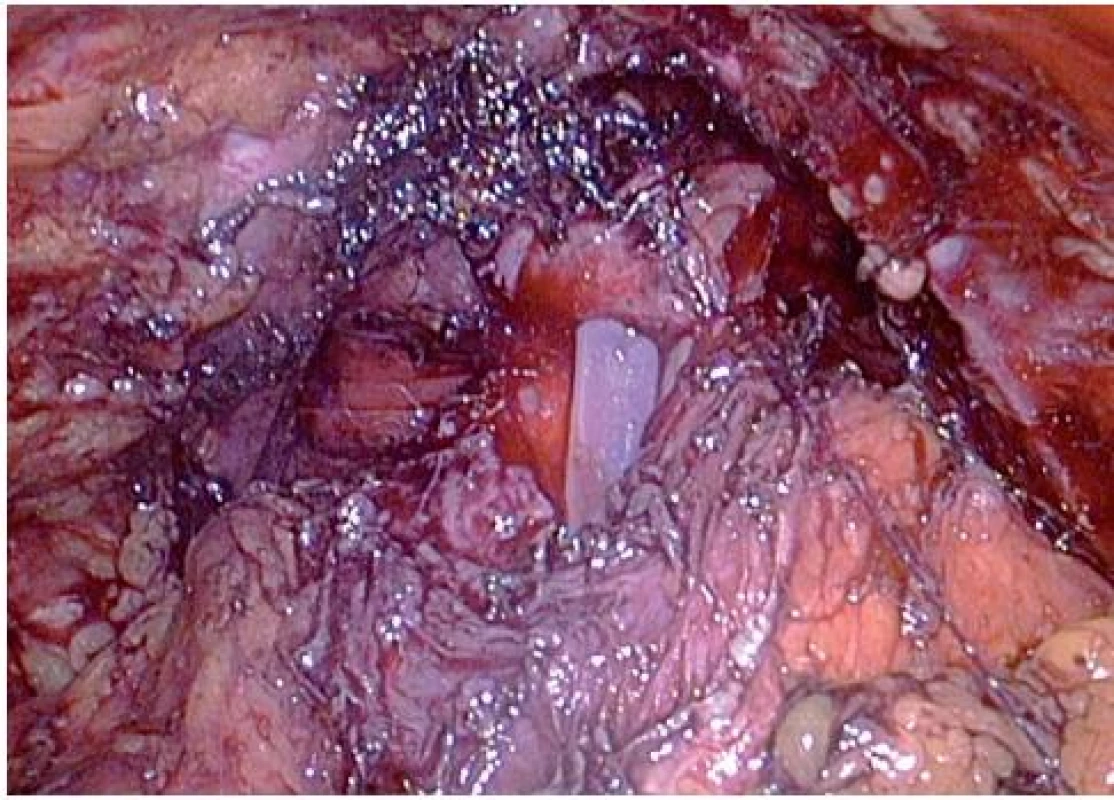 Veziko-uretrální anastomóza
Fig. 7. The vesico-urethral anastomosis
