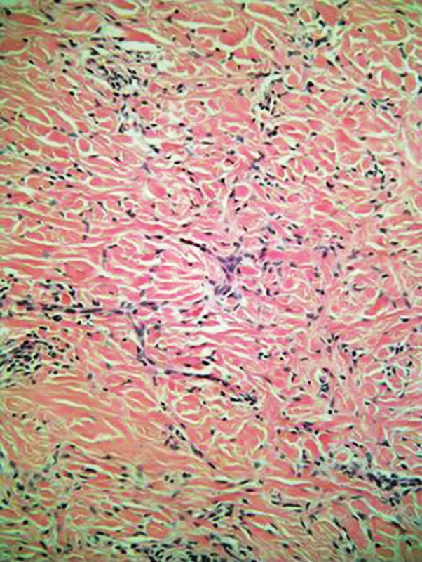 Tumor je tvořen vřetenitými buňkami blízkými fibroblastům, které často obkružují zesílené kolagenní snopce (HE, zvětšení 200x)