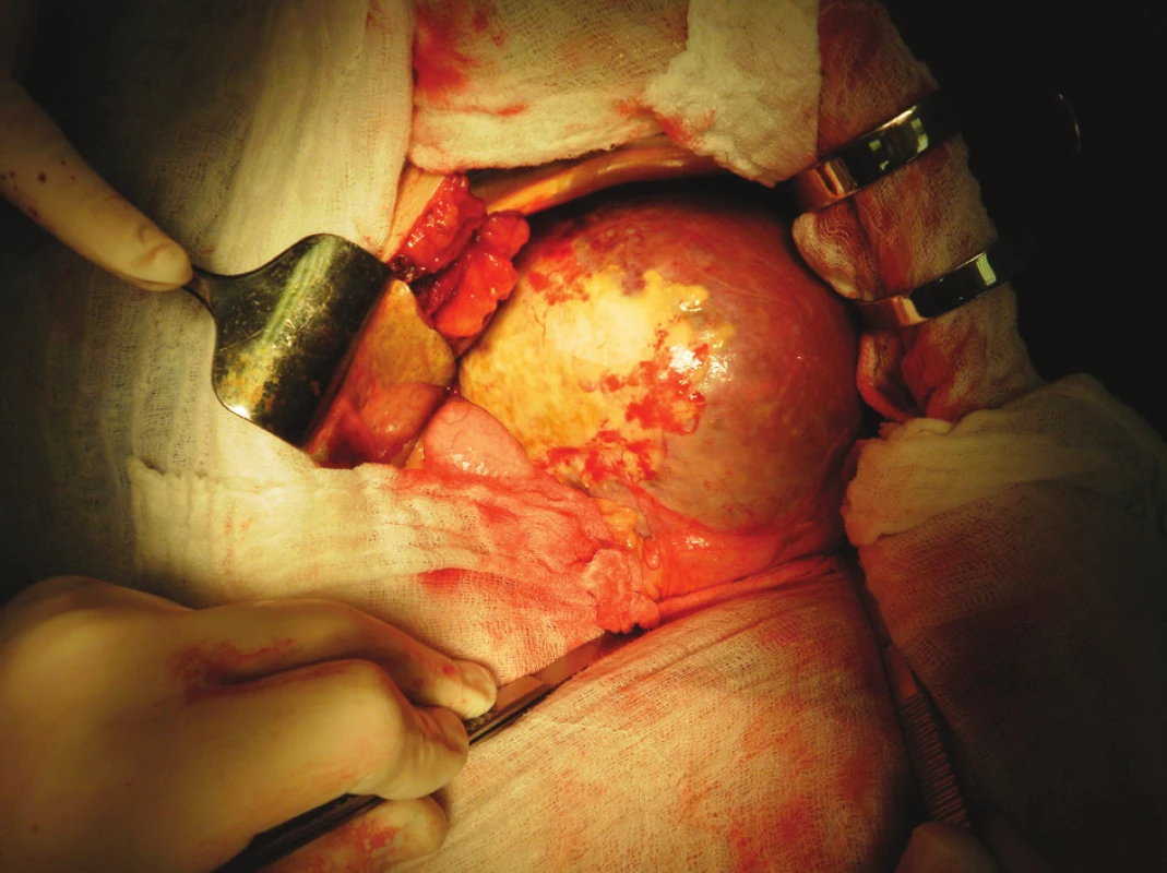 Poúrazová pseudocysta sleziny – peroperační nález
Fig. 4. Post-traumatic pseudocyst of the spleen on CT scan – intraoperative finding