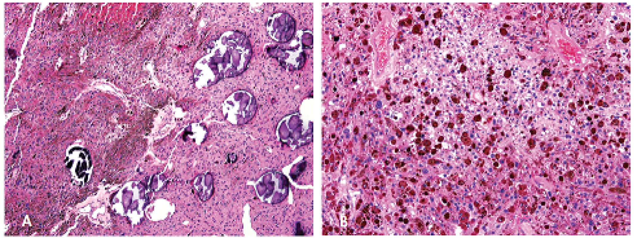 Psamomatózní melanotický schwannom složený z epiteloidních buněk s melaninovými granuly v cytoplazmu a ložisek kalcifikovaných psamomatozních tělisek. Barveno hematoxylinem eozinem (A, zvětšení 100x; B, zvětšení 200x).