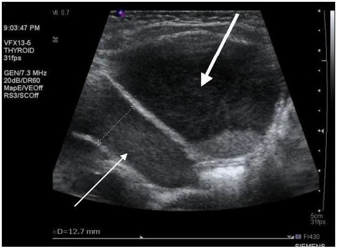 Ultrasonografie, pacient č. 2; silnější šipka ukazuje zvýšeně echogenní abnormální sediment v moči v močovém měchýři; slabší šipka ukazuje na podobný obsah v levém močovodu, který je rozšířen na 12,7 mm.

Fig. 1. Ultrasound, patient No 2; note increased echogenicity of urine sediment in the bladder (thick arrow); similar urine sediment is in the lumen of dilated (diameter 12.7 mm) left ureter (thin arrow).