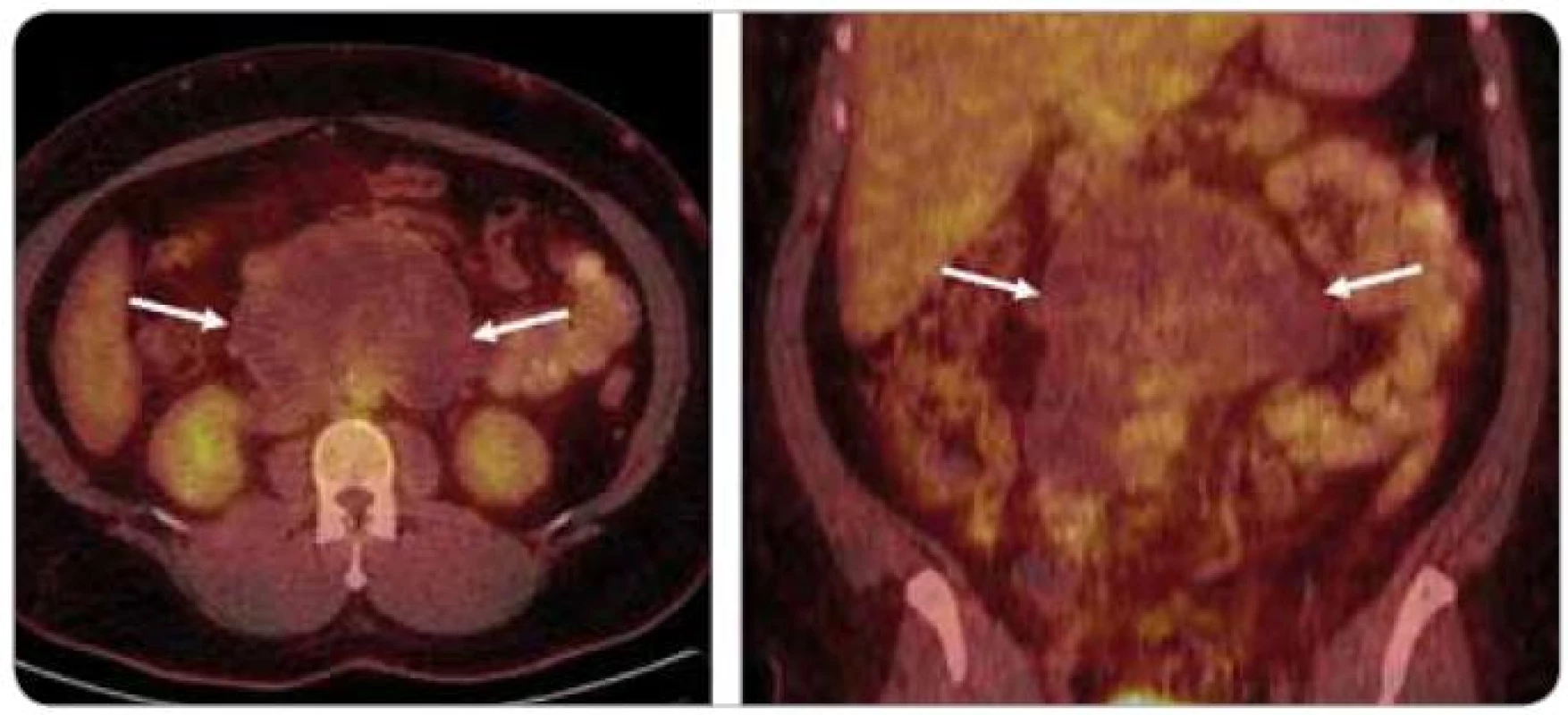 Retroperitoneální ametabolické nádorové reziduum u pacienta po vysokodávkované chemoterapii – nález je typický pro zralý teratom.