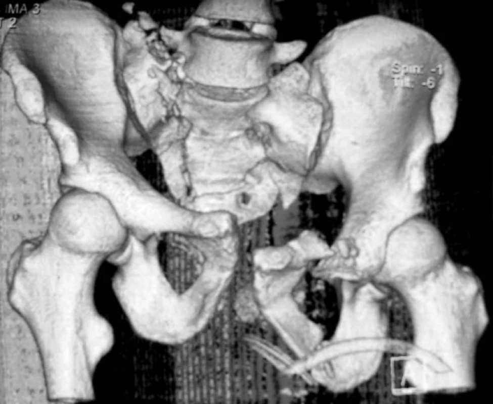 Kominutivní rotačně i vertikálně nestabilní fraktura pánve s frakturou obou ramének kosti stydké vlevo, symfýzeolýzou a kominutivní frakturou os sacrum oboustranně.