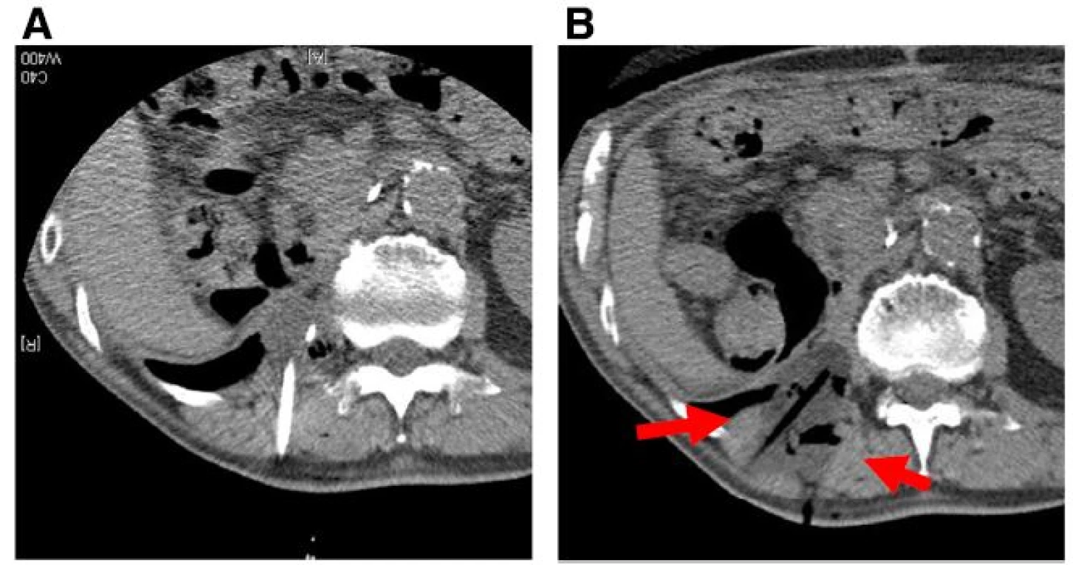 a, b. Multiple synergistic probes were inserted into the tumor to ensure complete encapsulation of the lesion by the ice ball. The ice ball was periodically monitored using CT to secure at least a 1-cm margin around the tumor